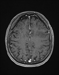 Cerebral amyloid angiopathy-related inflammation (Radiopaedia 58270-65377 Axial T1 C+ fat sat 104).jpg