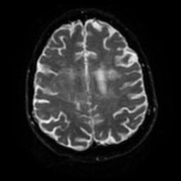 Cerebral amyloid angiopathy (Radiopaedia 28698-28978 Axial DWI 49).jpg