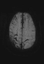 File:Cerebral amyloid angiopathy (Radiopaedia 29129-29518 Axial SWI MIP 24).jpg