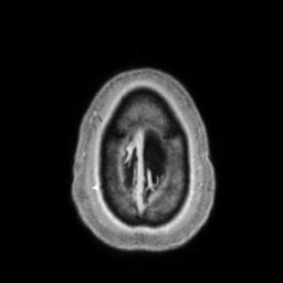 Cerebral amyloid angiopathy (Radiopaedia 29129-29518 Axial T1 C+ 143).jpg
