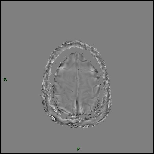 Cerebral amyloid angiopathy (Radiopaedia 77506-89664 H 92).jpg