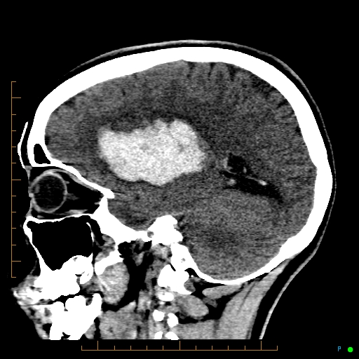 File:Cerebral arteriovenous malformation (AVM) (Radiopaedia 78162-90706 A 28).jpg