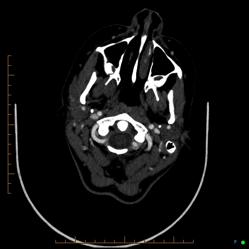 Cerebral arteriovenous malformation (AVM) (Radiopaedia 78162-90706 Axial CTA 36).jpg