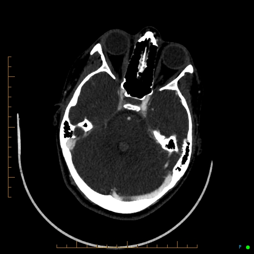 Cerebral arteriovenous malformation (AVM) (Radiopaedia 78162-90706 Axial CTA 97).jpg