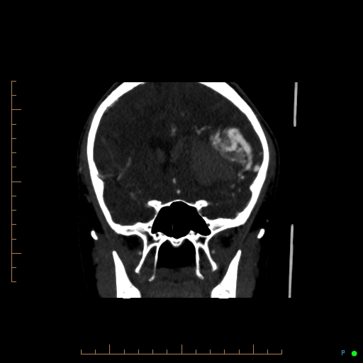 Cerebral arteriovenous malformation (AVM) (Radiopaedia 78162-90706 Coronal CTA 66).jpg
