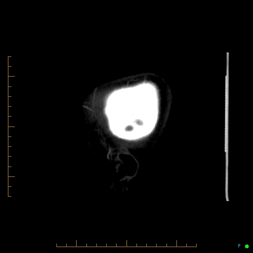 File:Cerebral arteriovenous malformation (AVM) (Radiopaedia 78162-90706 Sagittal CTA 74).jpg