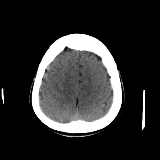 Cerebral arteriovenous malformation (Radiopaedia 28518-28759 Axial non-contrast 59).jpg