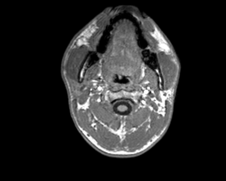 Cerebral arteriovenous malformation (Radiopaedia 30198-30813 Axial T1 58).jpg