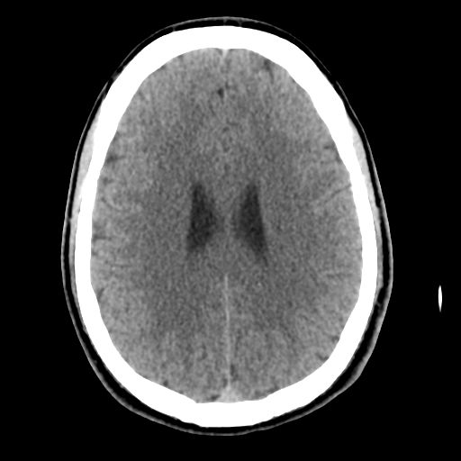File:Cerebral arteriovenous malformation (Radiopaedia 55798-62371 Axial non-contrast 36).png