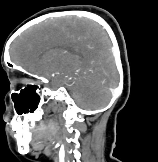 Cerebral arteriovenous malformation (Radiopaedia 73830-84645 D 37).jpg