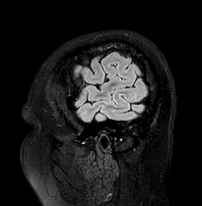 File:Cerebral arteriovenous malformation (Radiopaedia 74411-85746 Sagittal FLAIR 7).jpg