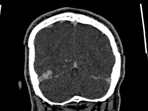 Cerebral arteriovenous malformation (Radiopaedia 78188-90746 Coronal C+ delayed 105).jpg