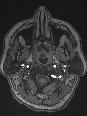 Cerebral arteriovenous malformation (Radiopaedia 84015-99245 Axial TOF 10).jpg