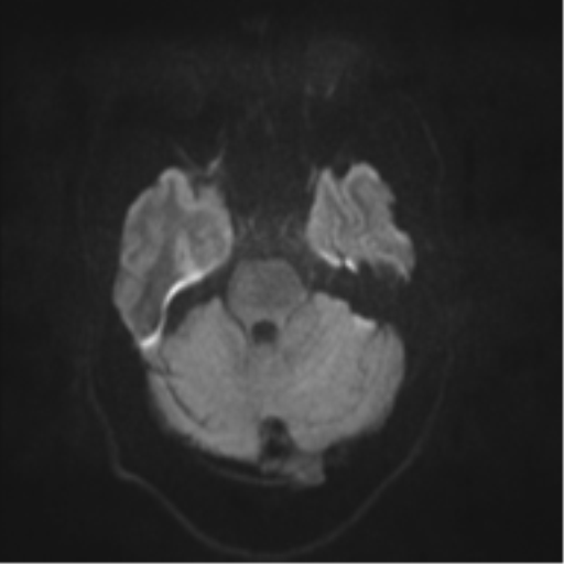 File:Cerebral arteriovenous malformation - huge (Radiopaedia 35734-37272 Axial DWI 30).png