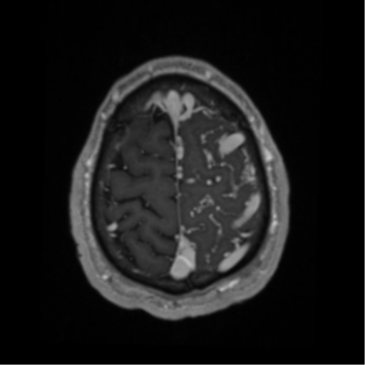 Cerebral arteriovenous malformation - huge (Radiopaedia 35734-37272 Axial T1 C+ 65).png
