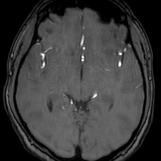 Cerebral arteriovenous malformation at posterior body of corpus callosum (Radiopaedia 74111-84925 Axial MRA 95).jpg