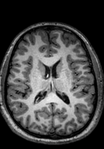 Cerebral arteriovenous malformation at posterior body of corpus callosum (Radiopaedia 74111-84925 Axial T1 121).jpg