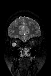 Cerebral arteriovenous malformation at posterior body of corpus callosum (Radiopaedia 74111-84925 Coronal T2 27).jpg
