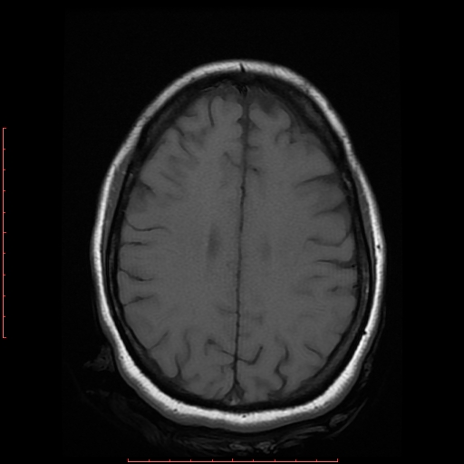 File:Cerebral cavernous malformation (Radiopaedia 26177-26306 Axial T1 15).jpg