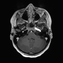 Cerebral cavernous venous malformation (Radiopaedia 70008-80021 Axial T1 C+ 14).jpg