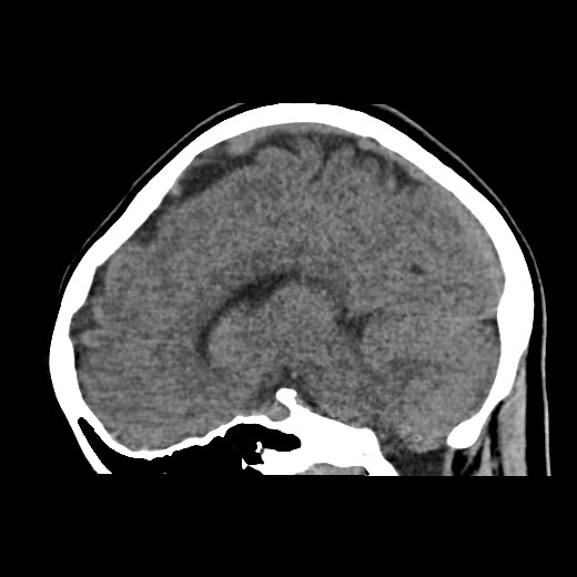 File:Cerebral cavernous venous malformation (Radiopaedia 70008-80022 C 26).jpg