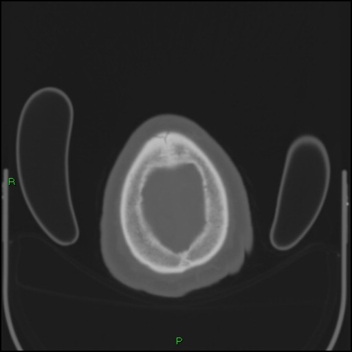 Cerebral contusions (Radiopaedia 33868-35039 Axial bone window 211).jpg