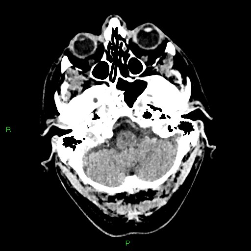 Cerebral contusions (Radiopaedia 33868-35039 Axial non-contrast 31).jpg