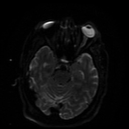 Cerebral embolic infarcts (embolic shower) (Radiopaedia 49837-55108 Axial DWI 32).jpg