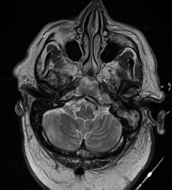 File:Cerebral embolic infarcts (embolic shower) (Radiopaedia 57395-64342 Axial T2 8).png