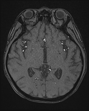 Cerebral embolic infarcts (embolic shower) (Radiopaedia 72391-82921 Axial MRA 81).jpg