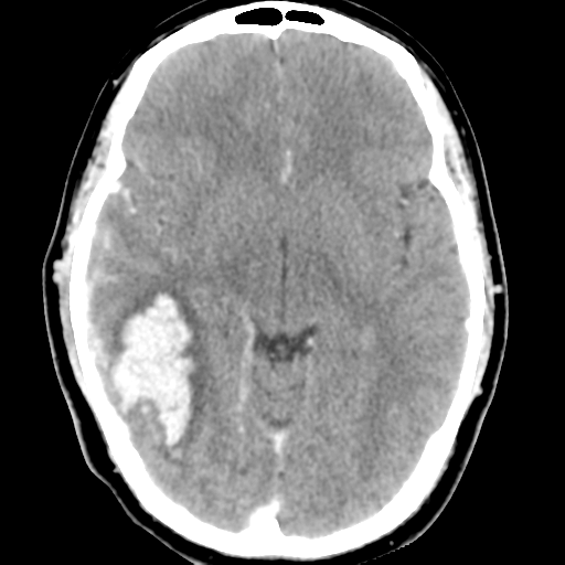 File:Cerebral hemorrhage secondary to arteriovenous malformation (Radiopaedia 33497-34561 B 25).png