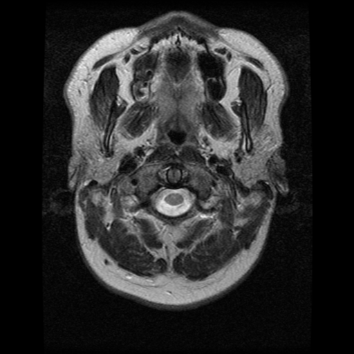 File:Cerebral hemorrhage secondary to arteriovenous malformation (Radiopaedia 33497-34572 Axial T2 1).png