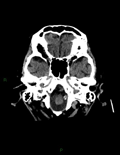 Cerebral metastases - ependymal and parenchymal (Radiopaedia 79877-93131 Axial non-contrast 7).jpg