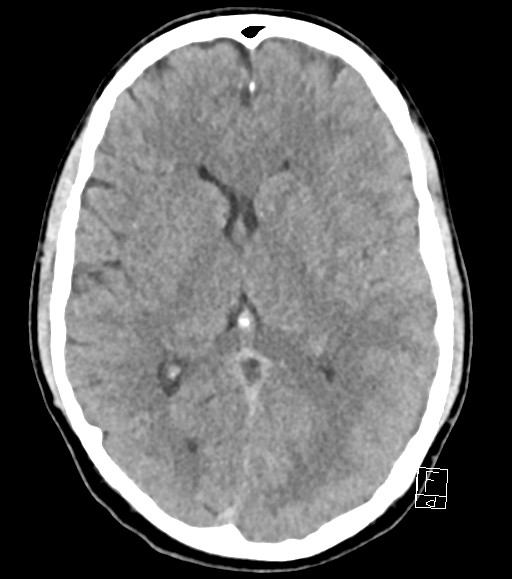 Cerebral metastases - testicular choriocarcinoma (Radiopaedia 84486-99855 Axial non-contrast 29).jpg