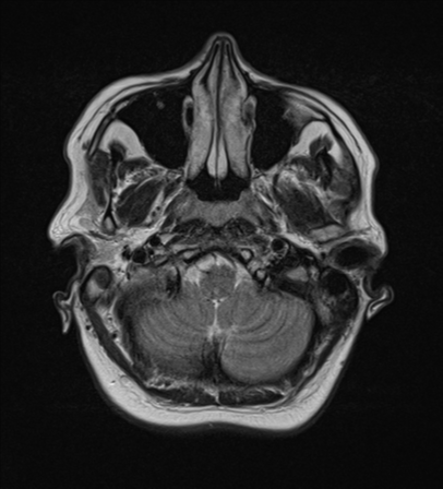File:Cerebral metastases mimicking abscesses (Radiopaedia 45841-50131 Axial T2 5).png