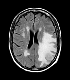 File:Cerebral metastasis (Radiopaedia 46744-51248 Axial FLAIR 17).png