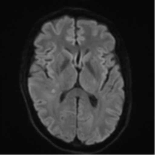 Cerebral metastasis - melanoma (Radiopaedia 54718-60954 Axial DWI 46).png