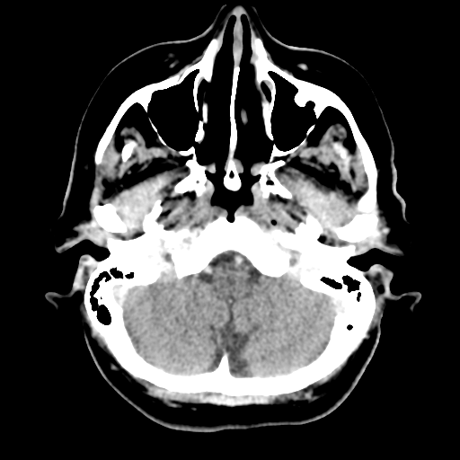 Cerebral metastasis to basal ganglia (Radiopaedia 81568-95412 Axial C+ delayed 13).png