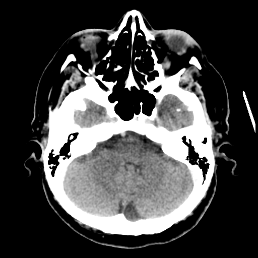 Cerebral metastasis to basal ganglia (Radiopaedia 81568-95412 Axial C+ delayed 17).png