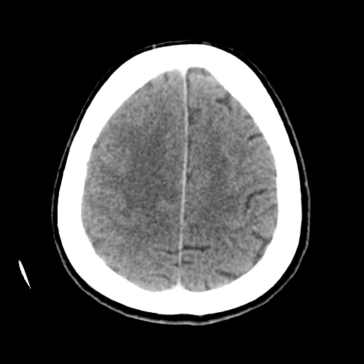 Cerebral metastasis to basal ganglia (Radiopaedia 81568-95412 Axial C+ delayed 45).png