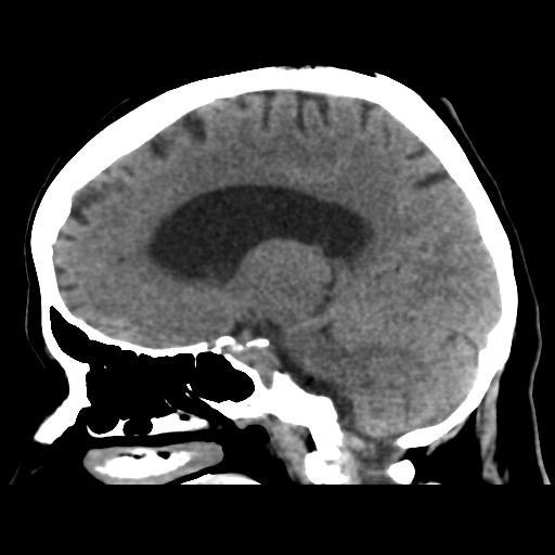 Cerebral metastasis to basal ganglia (Radiopaedia 81568-95412 E 36).png