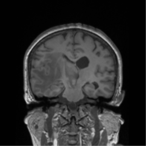 Cerebral metastasis to basal ganglia (Radiopaedia 81568-95413 Coronal T1 22).png