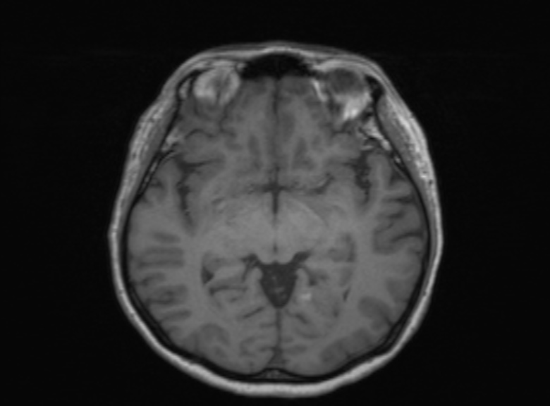 Cerebral ring enhancing lesions - cerebral metastases (Radiopaedia 44922-48817 Axial T1 244).jpg