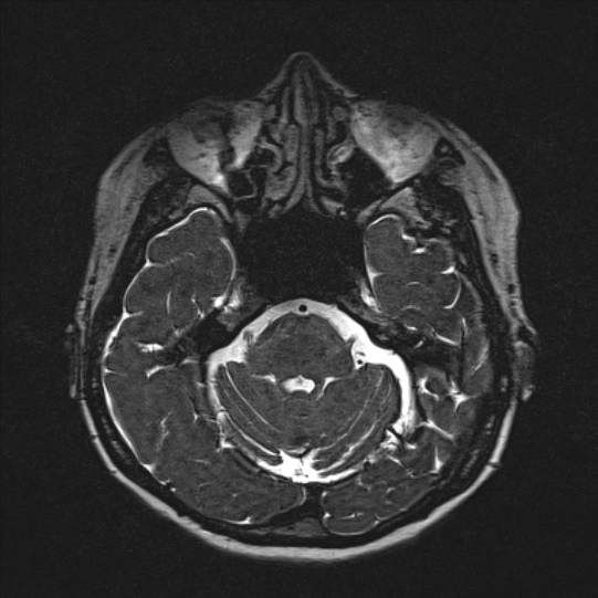 Cerebral ring enhancing lesions - cerebral metastases (Radiopaedia 44922-48817 F 46).jpg