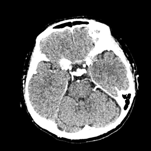 Cerebral ring enhancing lesions - cerebral metastases (Radiopaedia 44922-48818 B 100).jpg