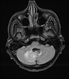 File:Cerebral toxoplasmosis (Radiopaedia 43956-47461 Axial FLAIR 5).jpg