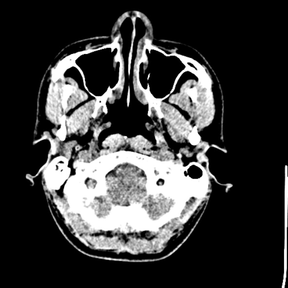 Cerebral toxoplasmosis (Radiopaedia 53993-60131 Axial non-contrast 10).jpg