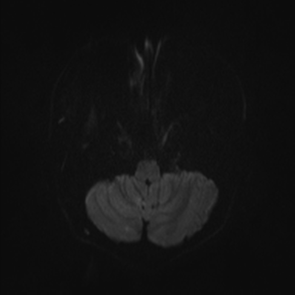 Cerebral toxoplasmosis (Radiopaedia 53993-60132 Axial DWI 31).jpg