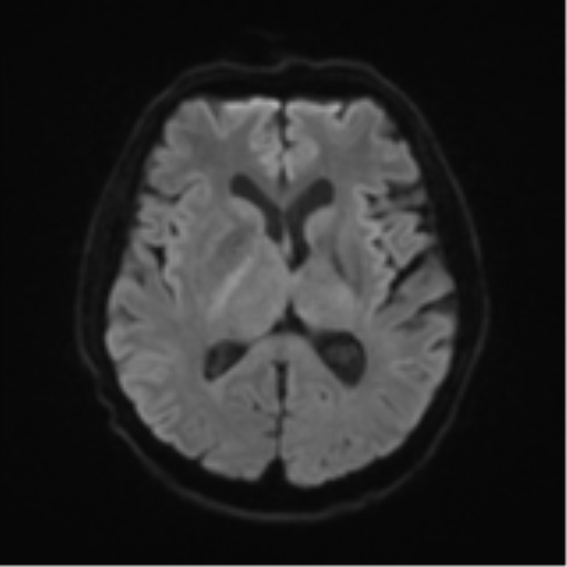 Cerebral toxoplasmosis (Radiopaedia 54575-60804 Axial DWI 50).png