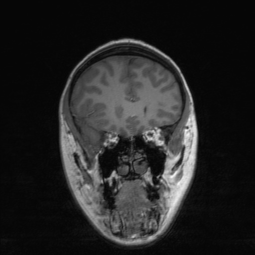 Cerebral tuberculosis with dural sinus invasion (Radiopaedia 60353-68090 Coronal T1 58).jpg